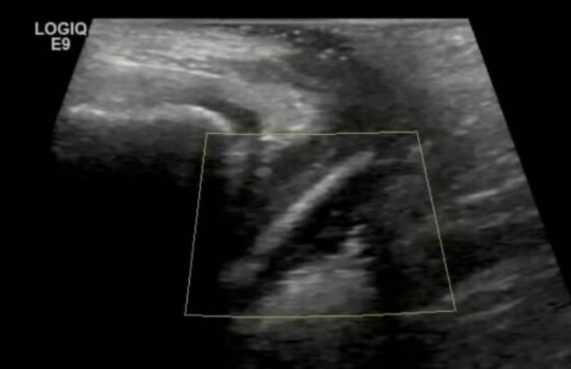  【妇科前沿】儿童阴道异物取出技术全解析：微创内镜如何实现零损伤 健康养生